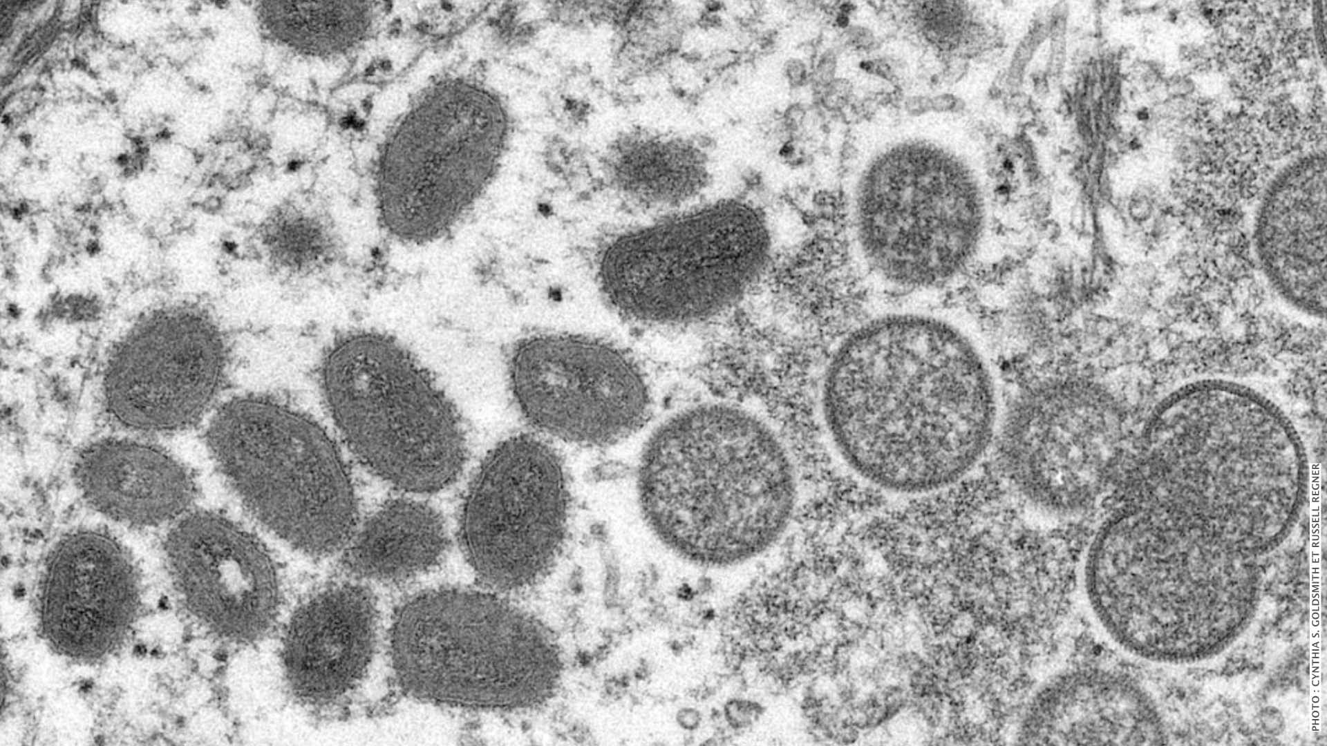 Canadá confirma cinco casos de viruela del mono
